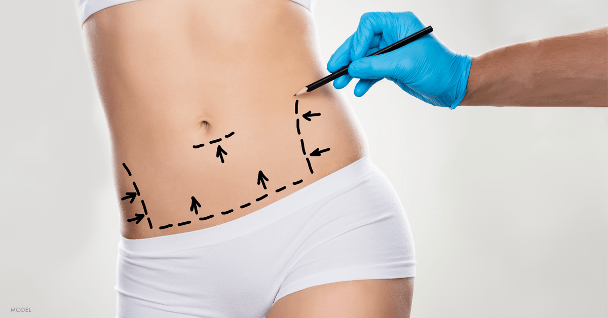 Your Tummy Tuck Recovery Timeline - Center for Plastic Surgery