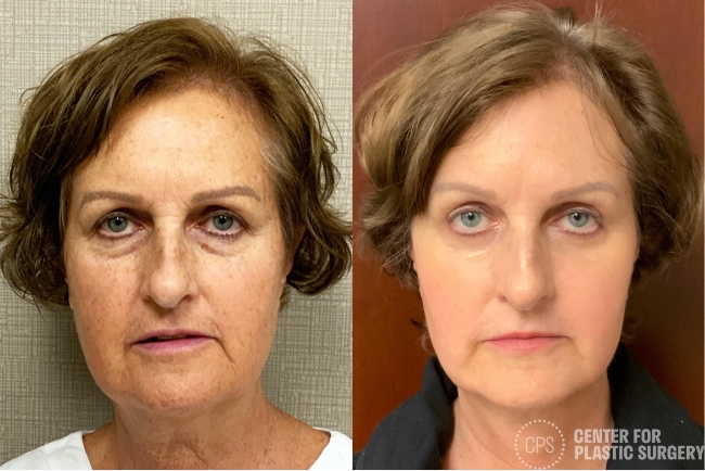 Before and after Face360 on 63 year old woman