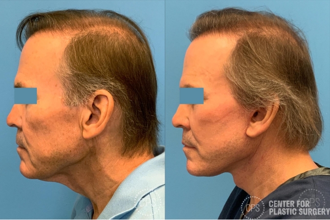 Before and after Face360 on 66 year old man