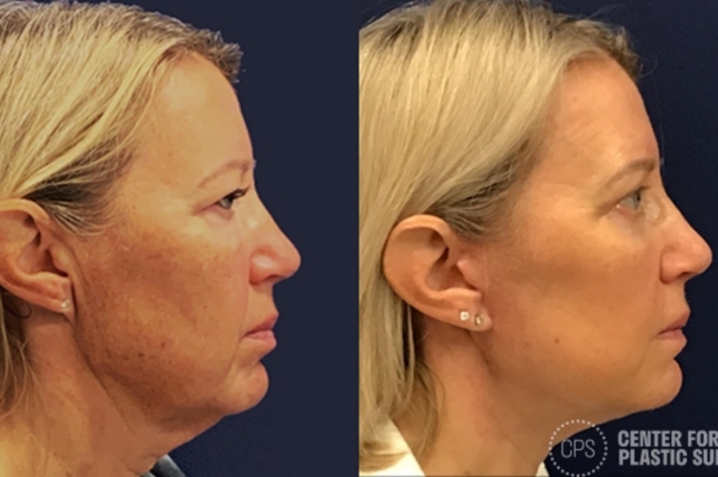 Before and after Face360 on 53 year old woman