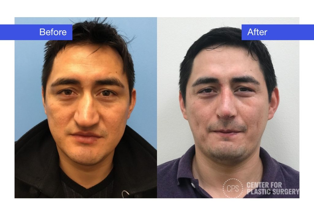 Male Rhinoplasty Before & After (Actual Patient)
