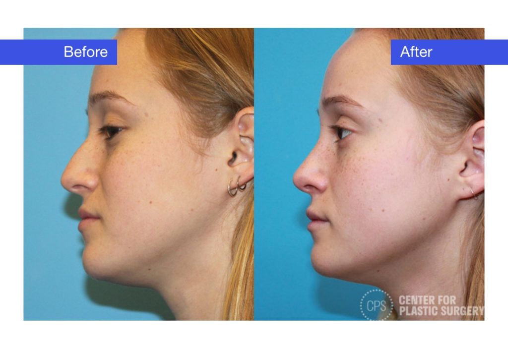 Female Rhinoplasty Before & After (Actual Patient)
