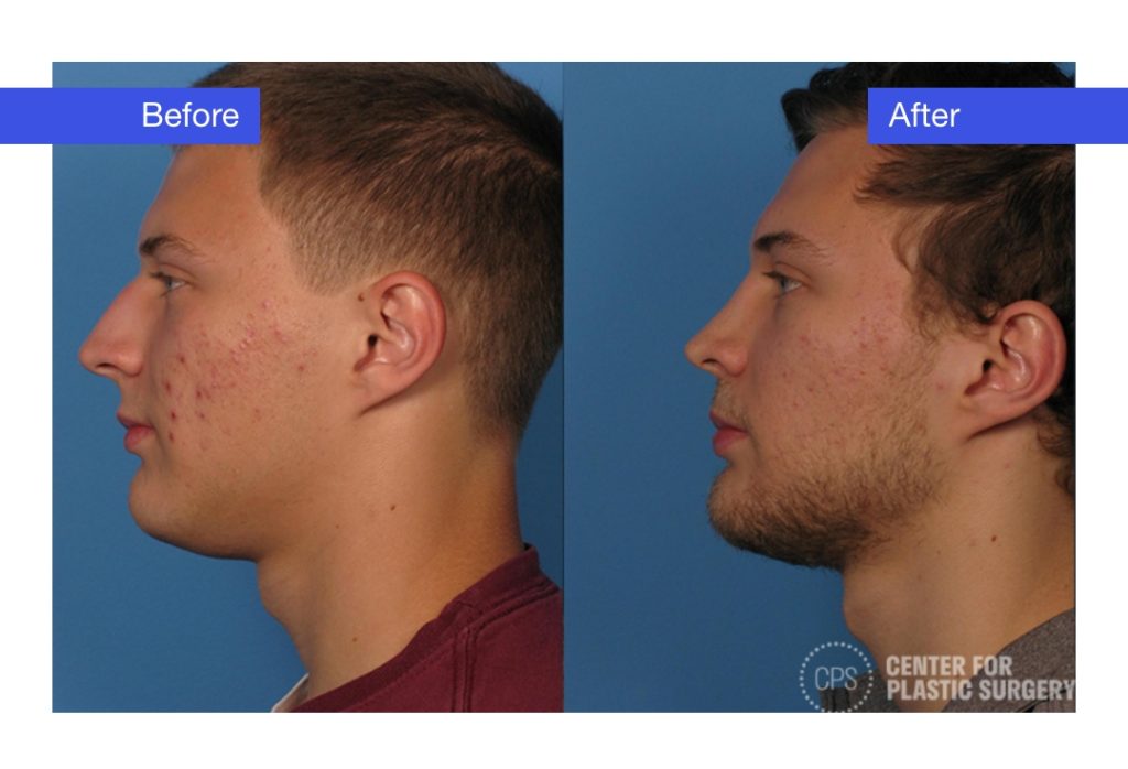 Male Rhinoplasty Before & After (Actual Patient)