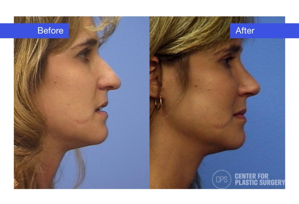 Female Rhinoplasty Before & After (Actual Patient)