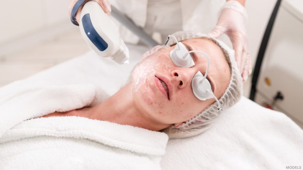 Woman laying down receiving acne scar treatment (models)
