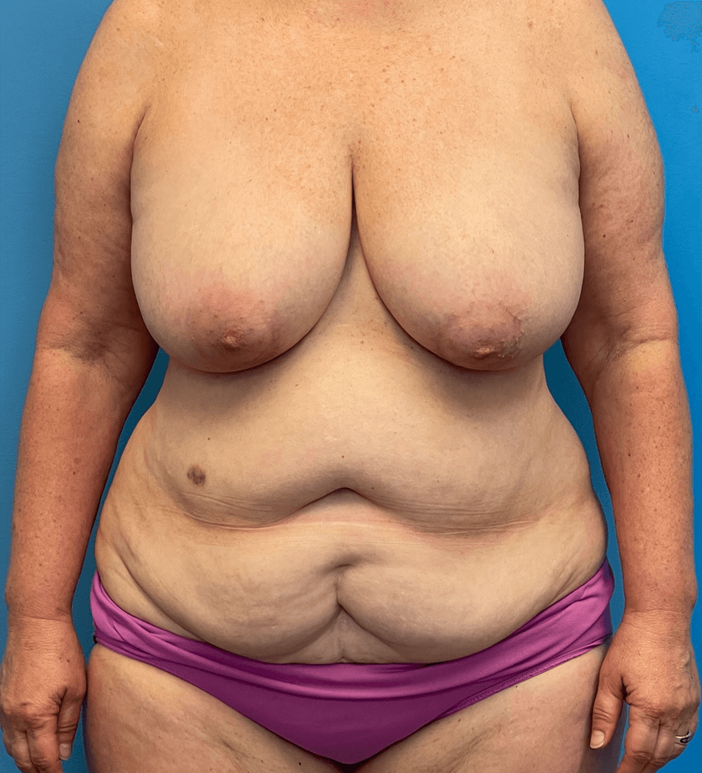 Before mommy makeover, front view