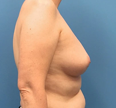 Case--135 | Before Breast Reconstruction 3