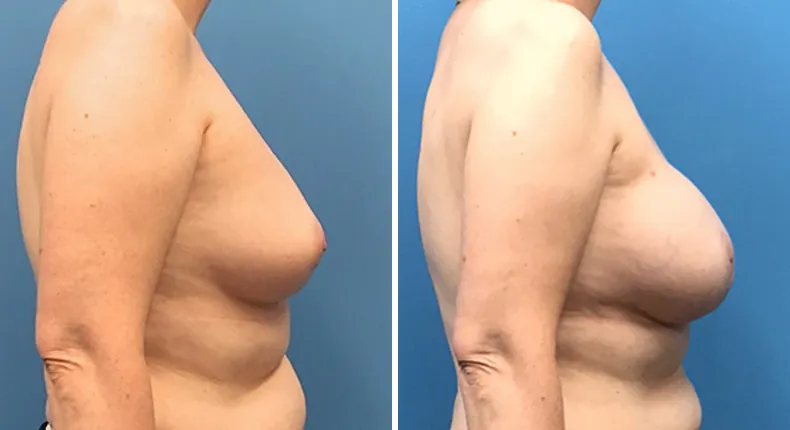 Before and after breast reconstruction: woman's breasts from the right side