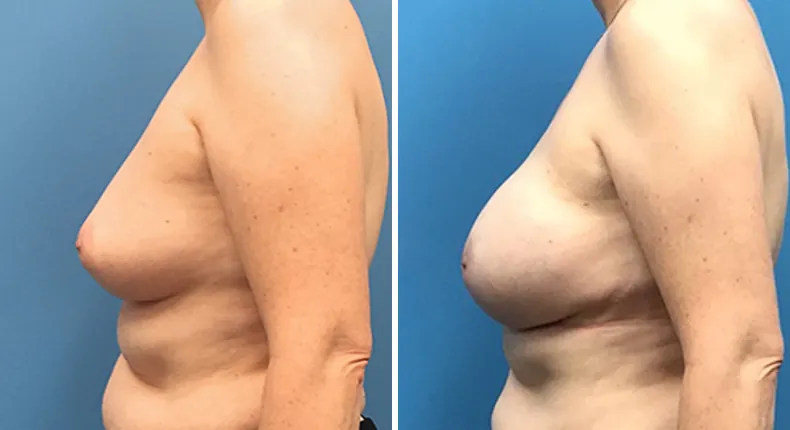 Before and after breast reconstruction: woman's breasts from the left side