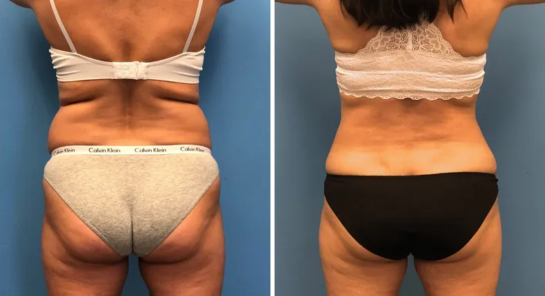 Before and after tummy tuck: woman's abdomen from the back, with liposuction