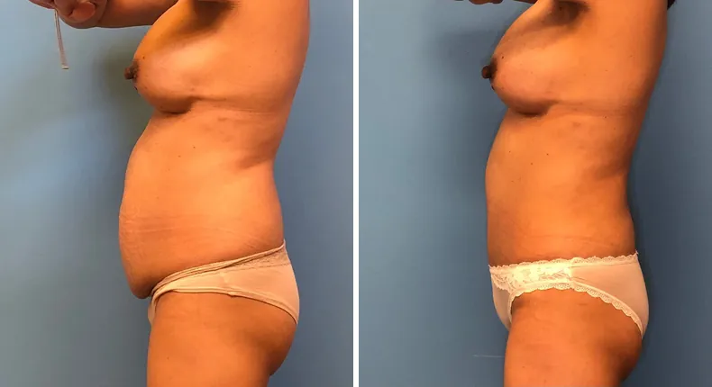 Before and after tummy tuck: woman's abdomen from the left side, with breast reconstruction