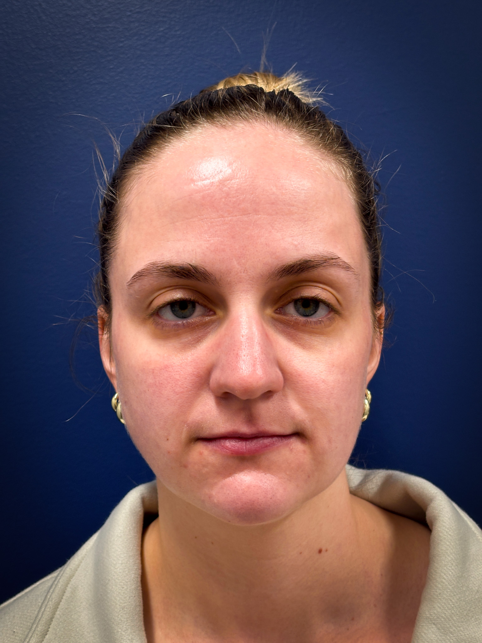 Liposuction-Case--4705 | After Liposuction 1