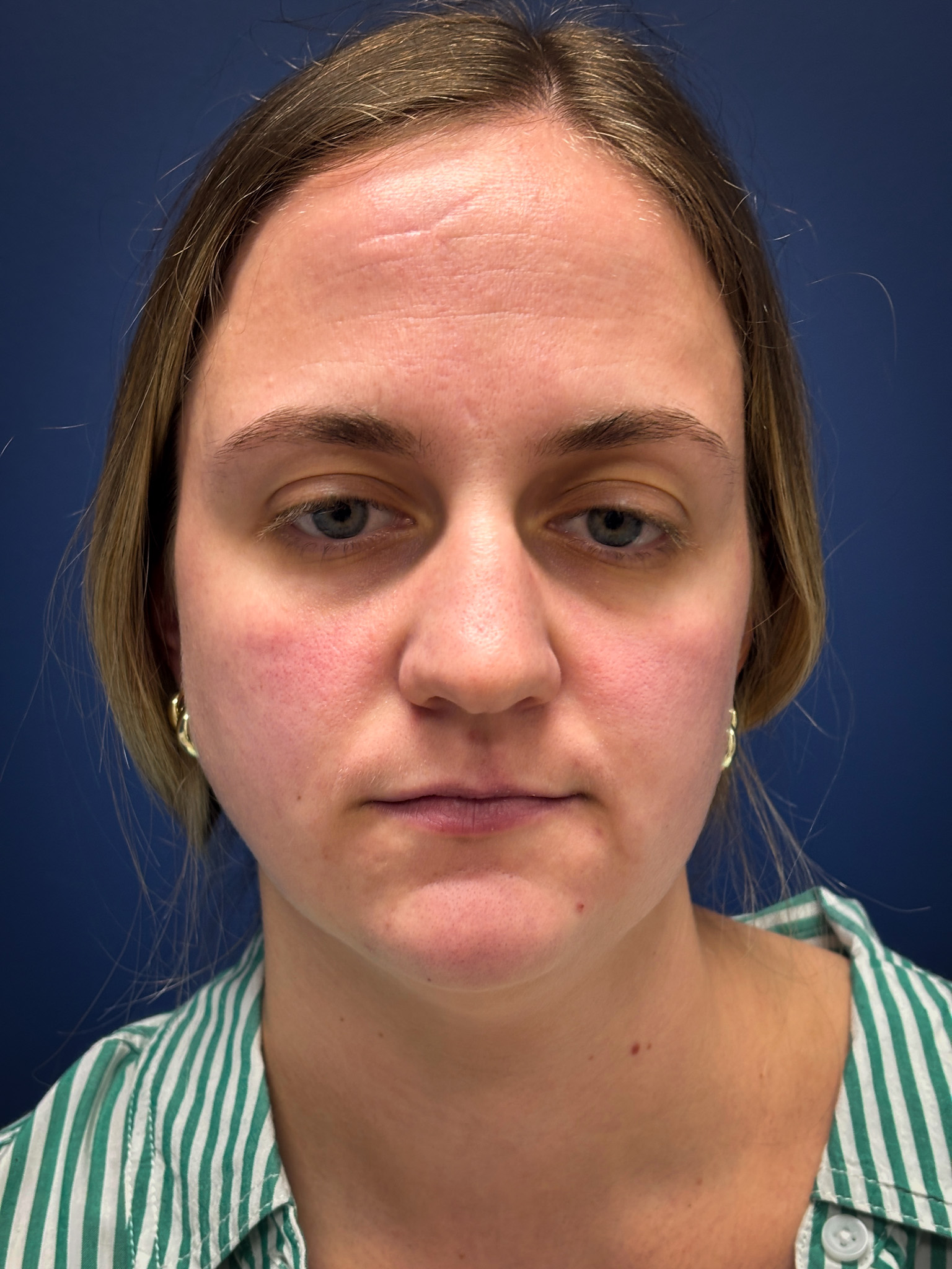 Liposuction-Case--4705 | Before Liposuction 1