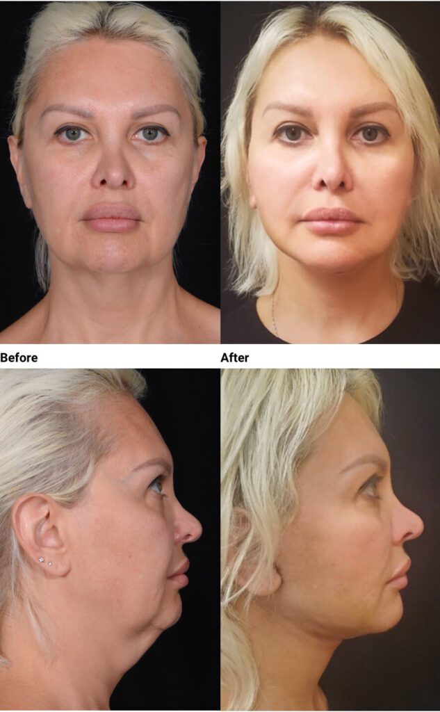 Actual Patient Results