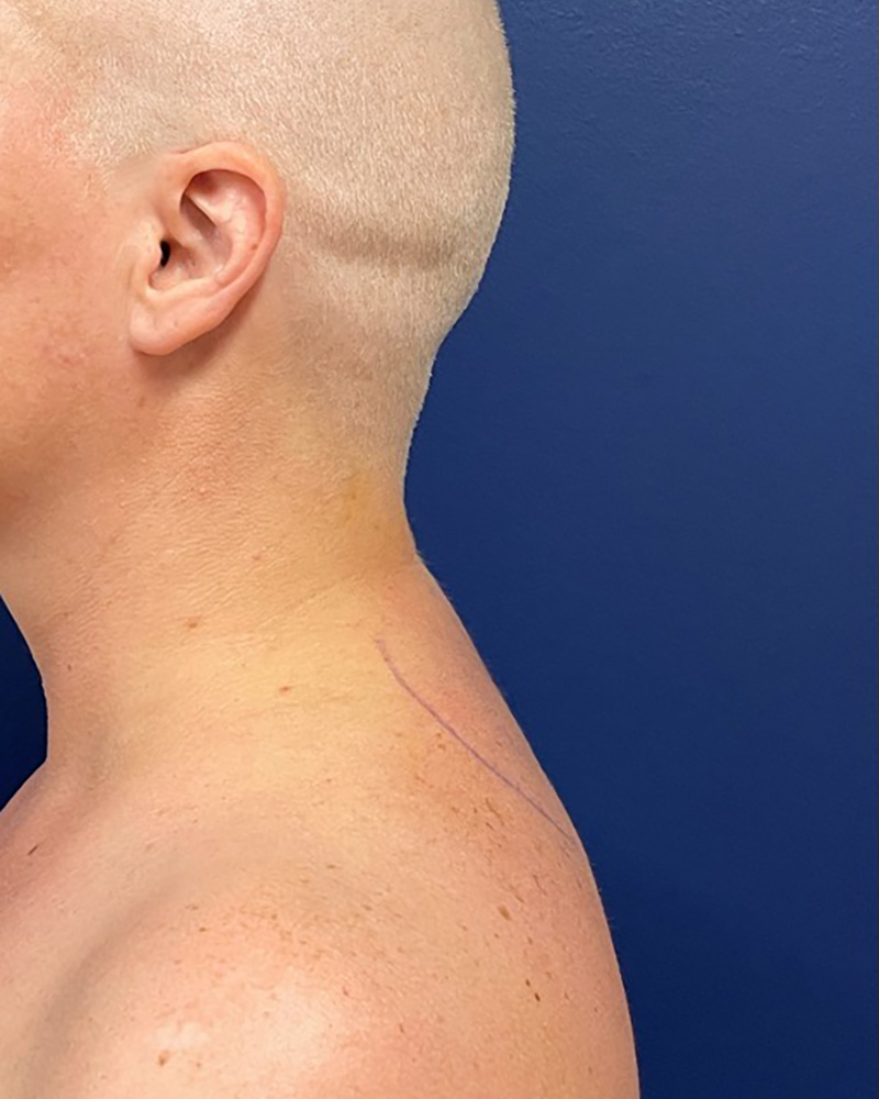 Case--9534 | After Liposuction 1