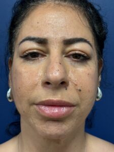 Facelift-Case--8534 | After Facelift 1