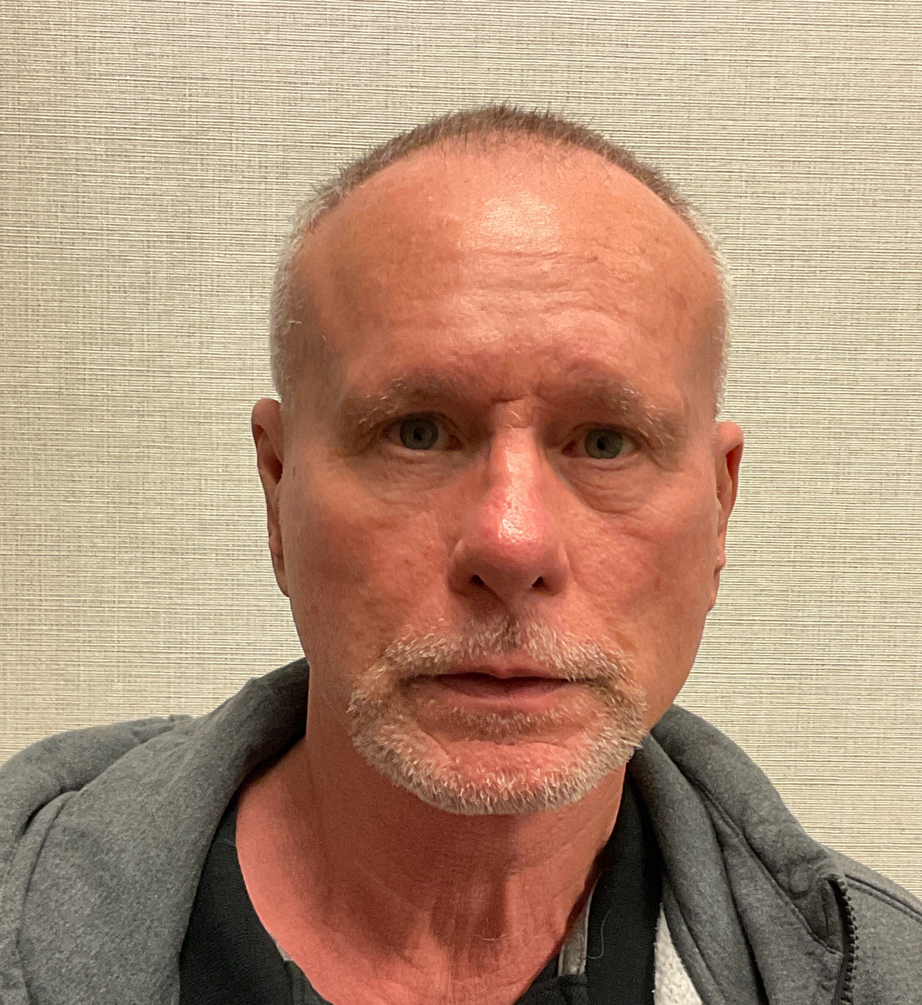 Facelift-Case--7592 | After Facelift 1