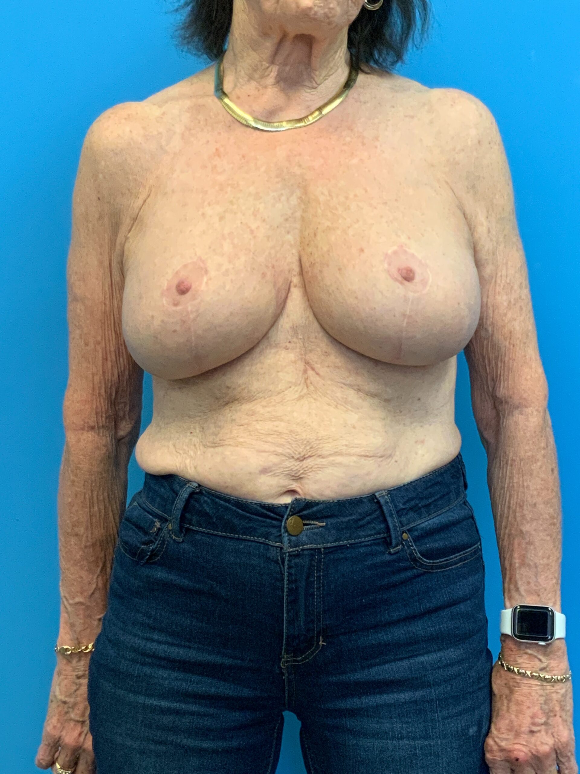 Augmentation-Mastopexy-Case--4504 | After Breast Augmentation With Lift 1