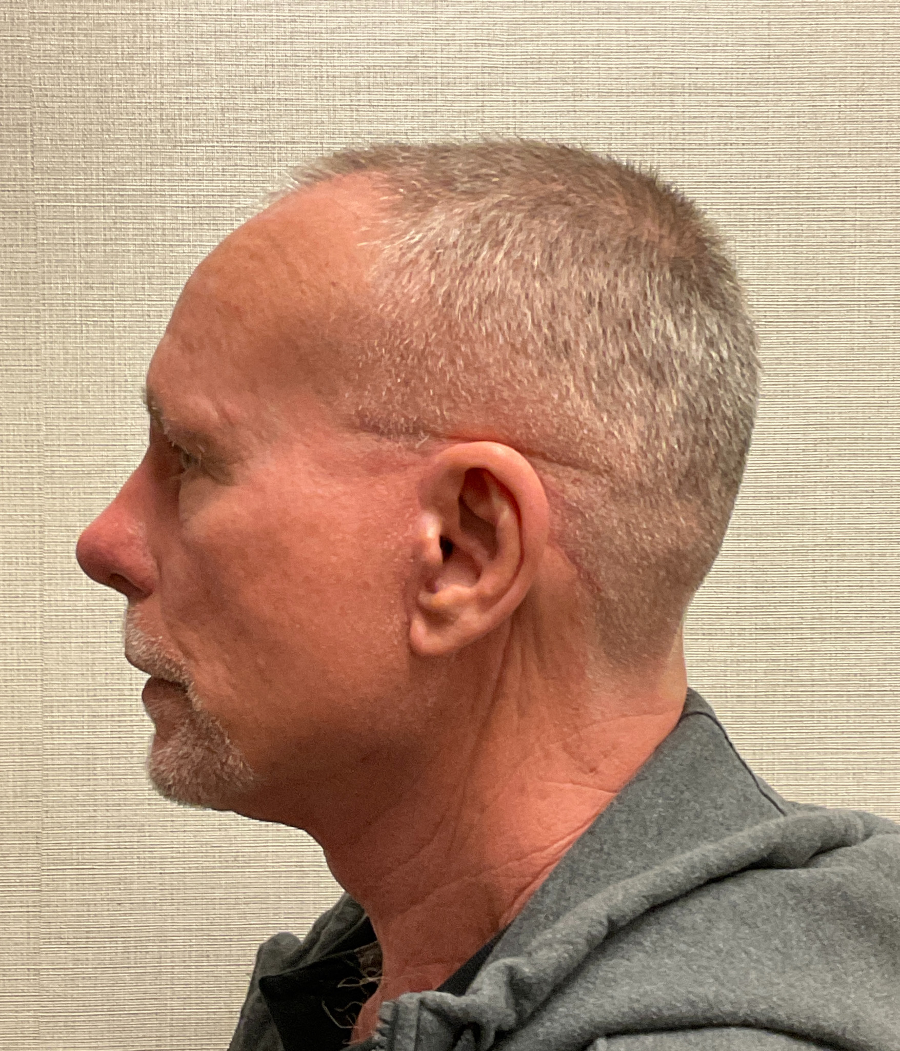 Facelift-Case--7592 | After Facelift 2