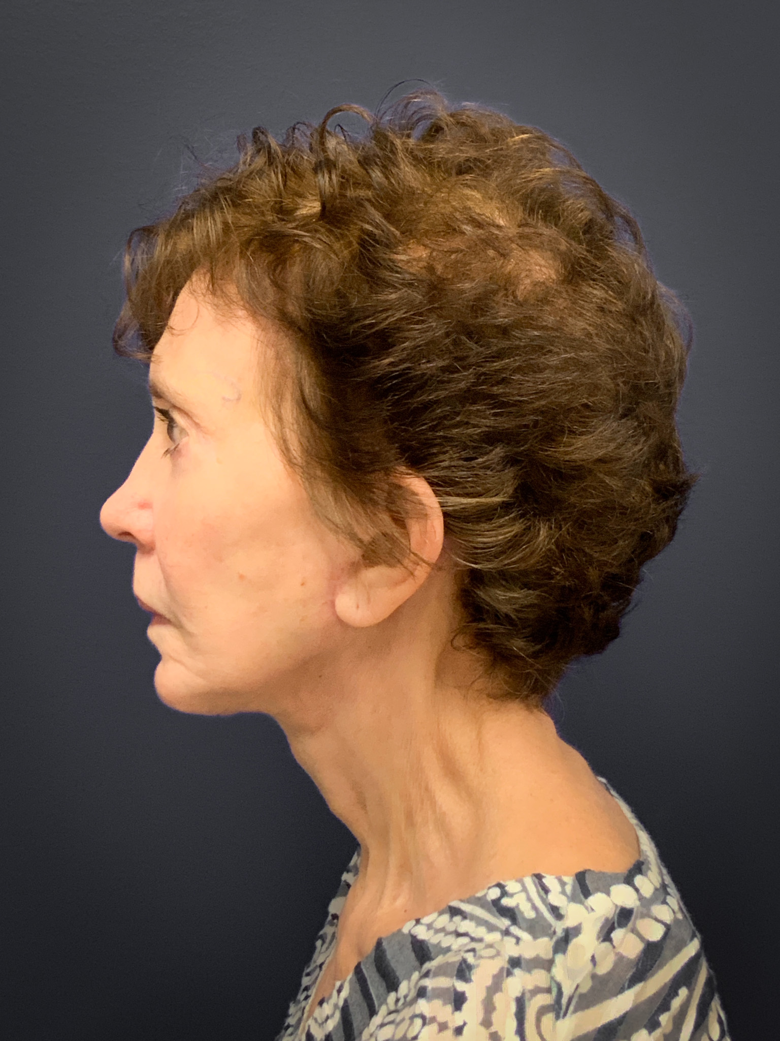 Facelift-Case--8727 | After Facelift 2