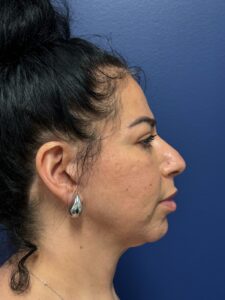 Facelift-Case--8534 | After Facelift 2