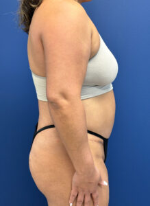 Abdominoplasty-Case--9870 | After Tummy Tuck 2