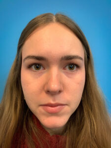 Rhinoplasty-Case--6484 | After Rhinoplasty 1