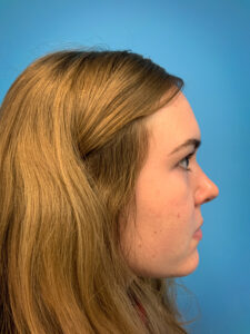 Rhinoplasty-Case--6484 | After Rhinoplasty 2