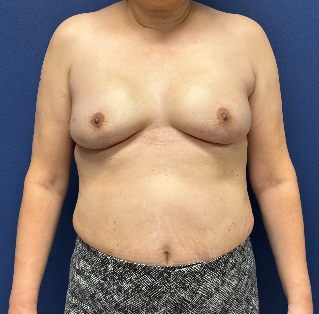Breast-Reconstruction-Case--28751 | After Breast Reconstruction 1