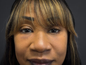 Facelift-Lower-Blepharoplasty-Case--6866 | After Facelift 2