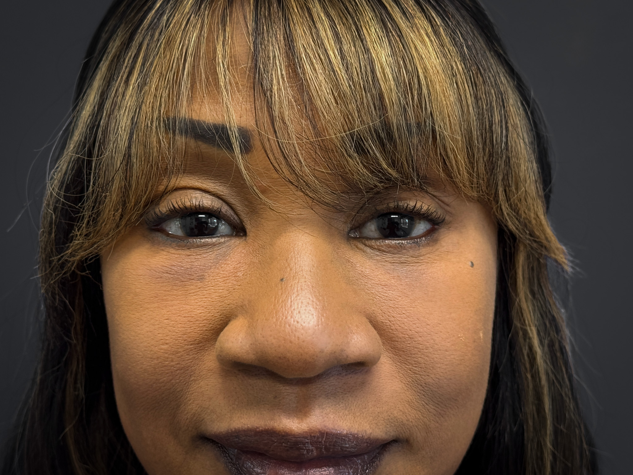 Facelift-Lower-Blepharoplasty-Case--6866 | After Facelift 2