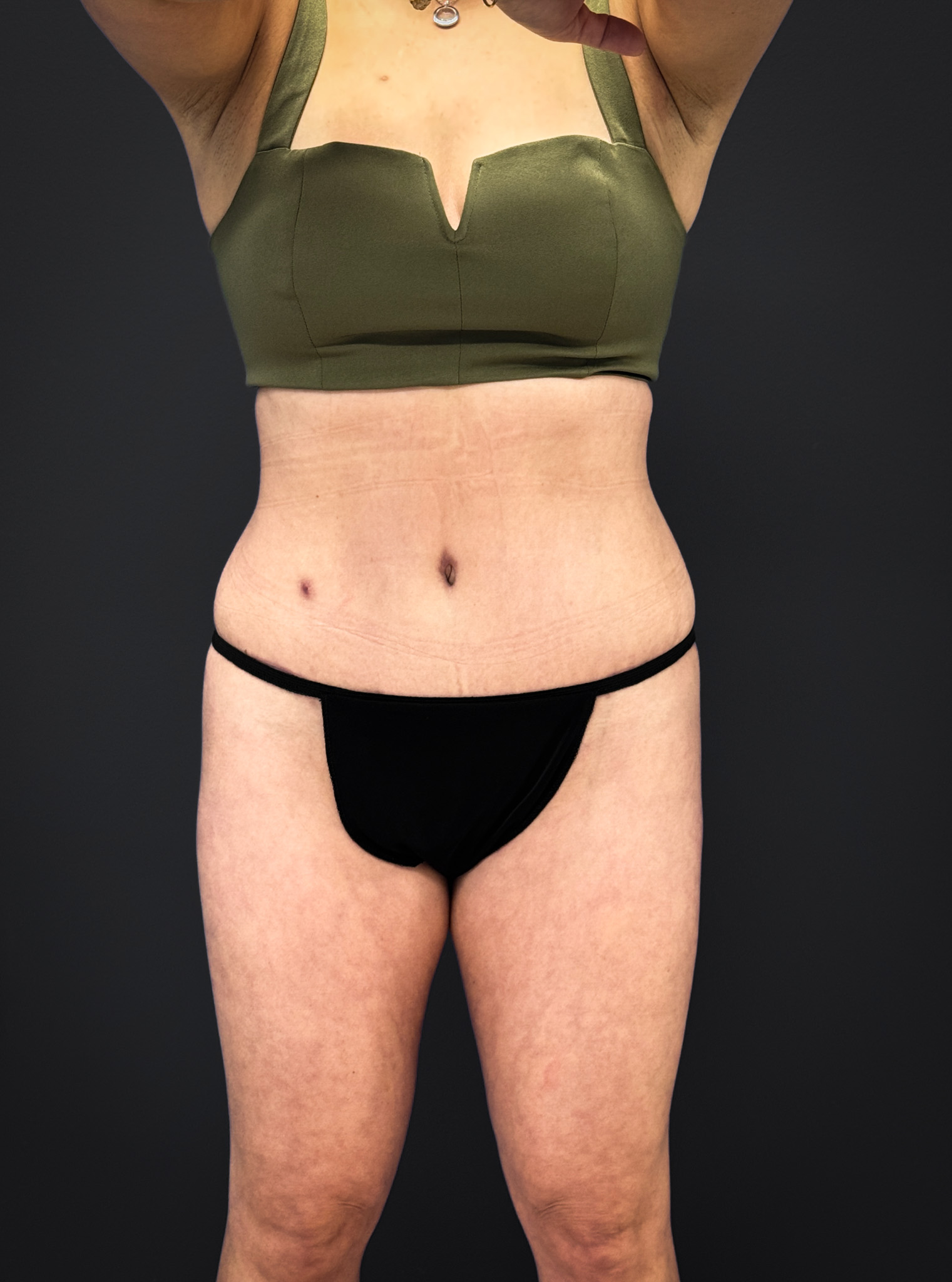 Tummy-Tuck-Case--3757 | After Tummy Tuck 1