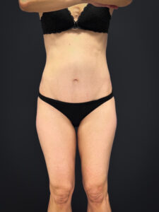 Tummy-Tuck-Case--2729 | After Tummy Tuck 1