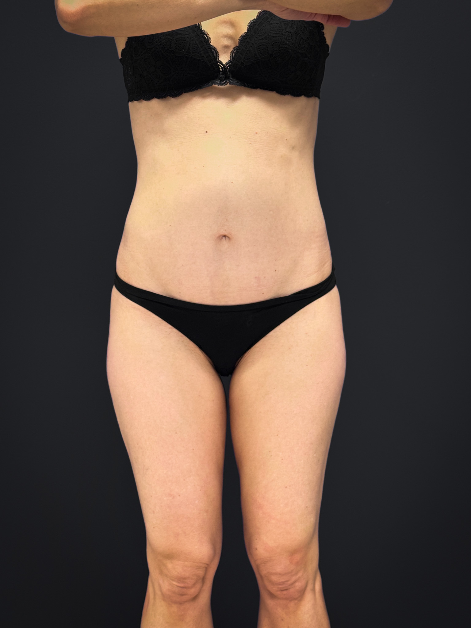 Tummy-Tuck-Case--2729 | After Tummy Tuck 1