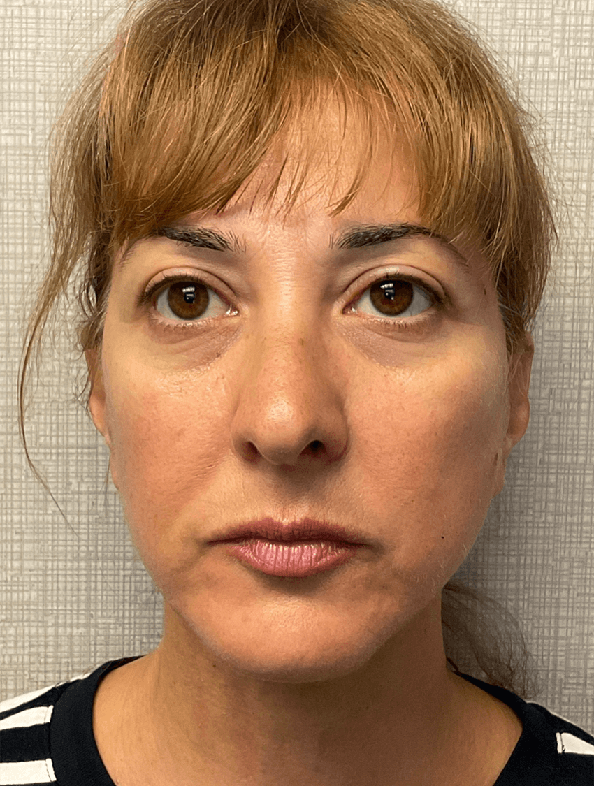 Case--20575 | After Facelift 1