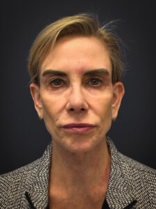 Facelift-Case--4219 | After Facelift 1