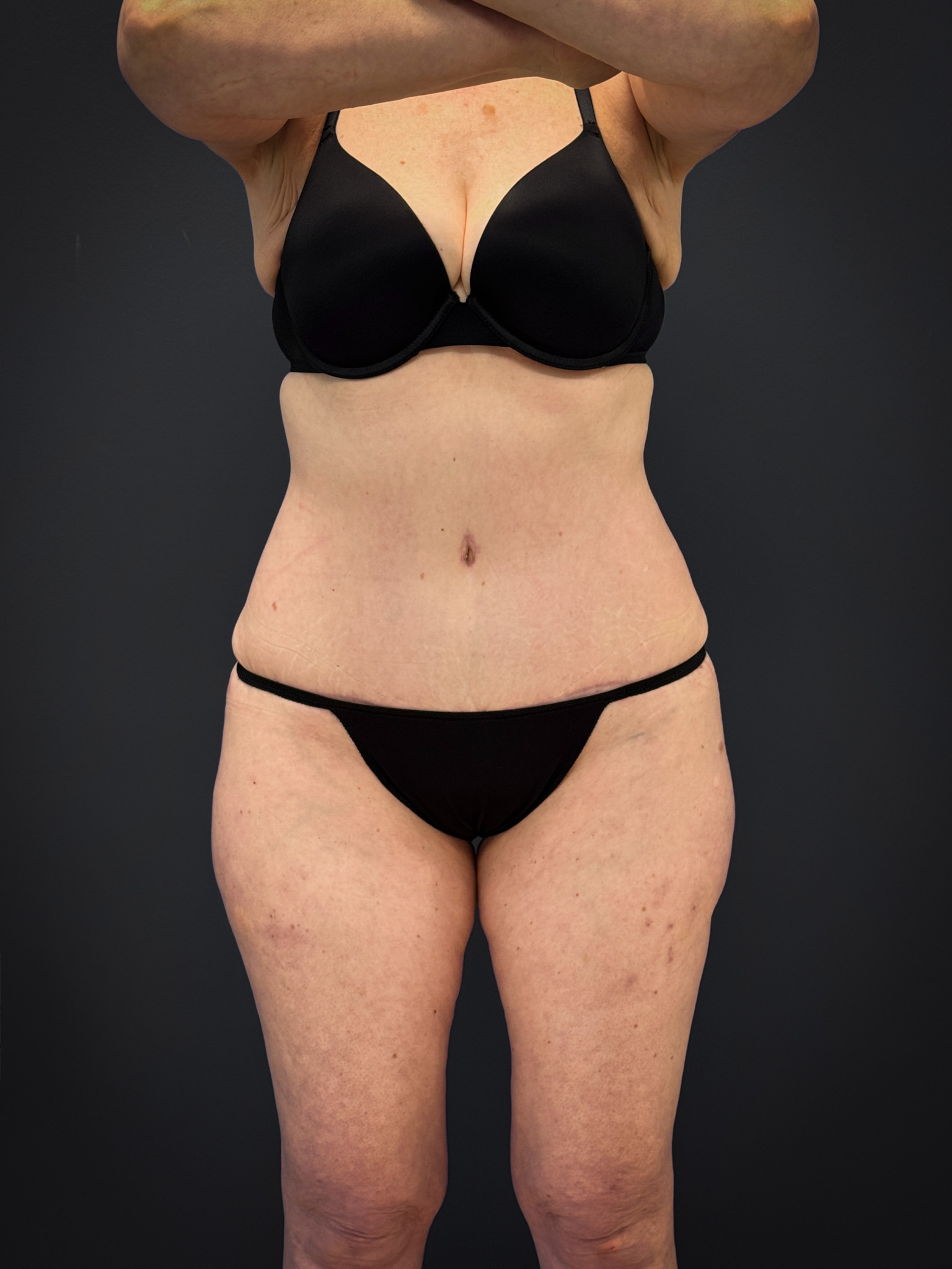 Tummy-Tuck-Case--7170 | After Tummy Tuck 1