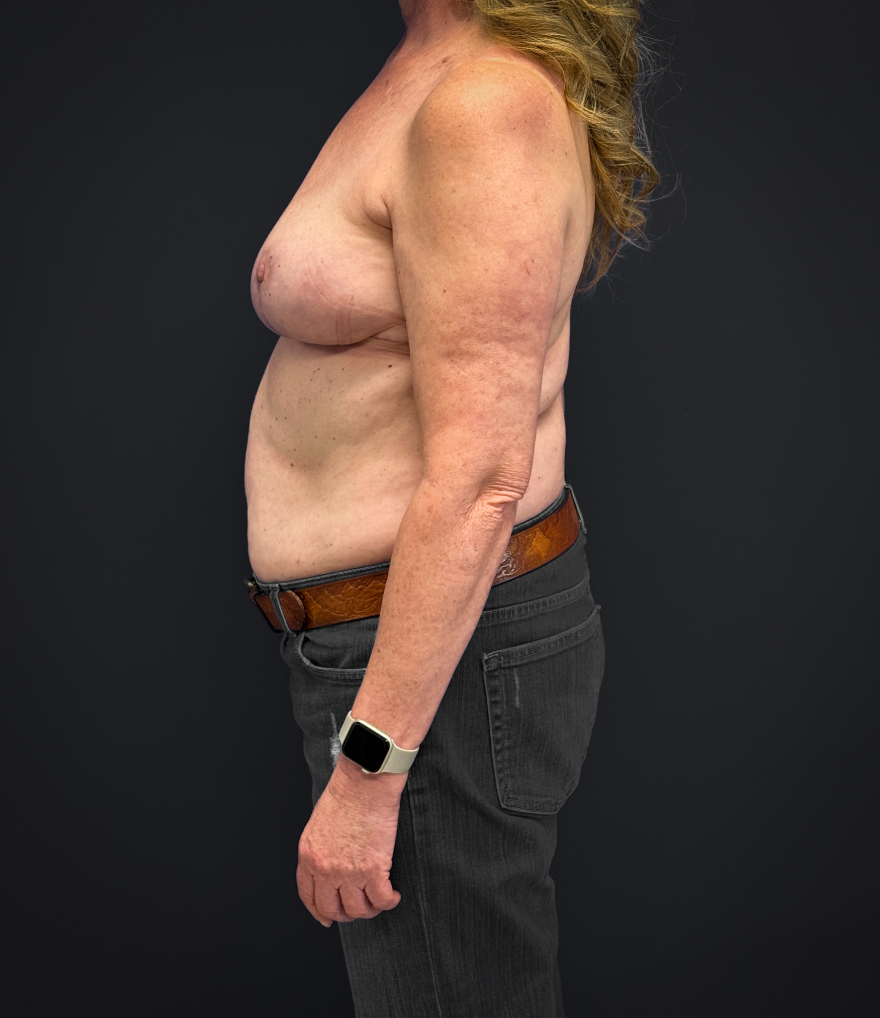 After Mastopexy and Galaflex (Left side profile)