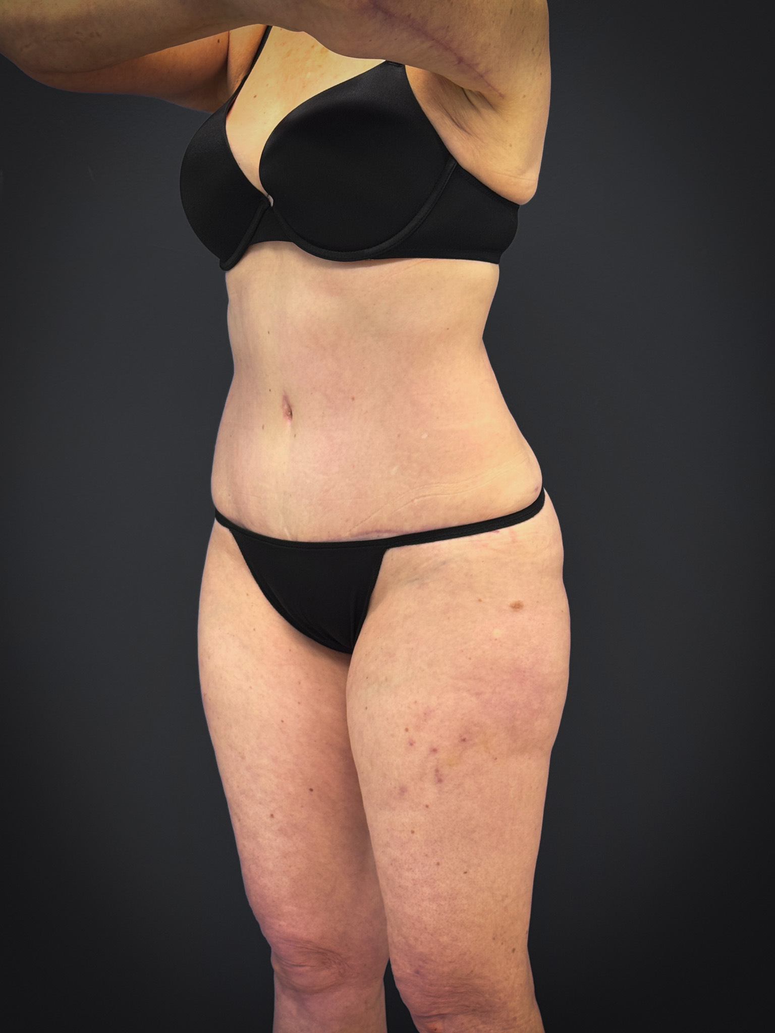 Tummy-Tuck-Case--7170 | After Tummy Tuck 2