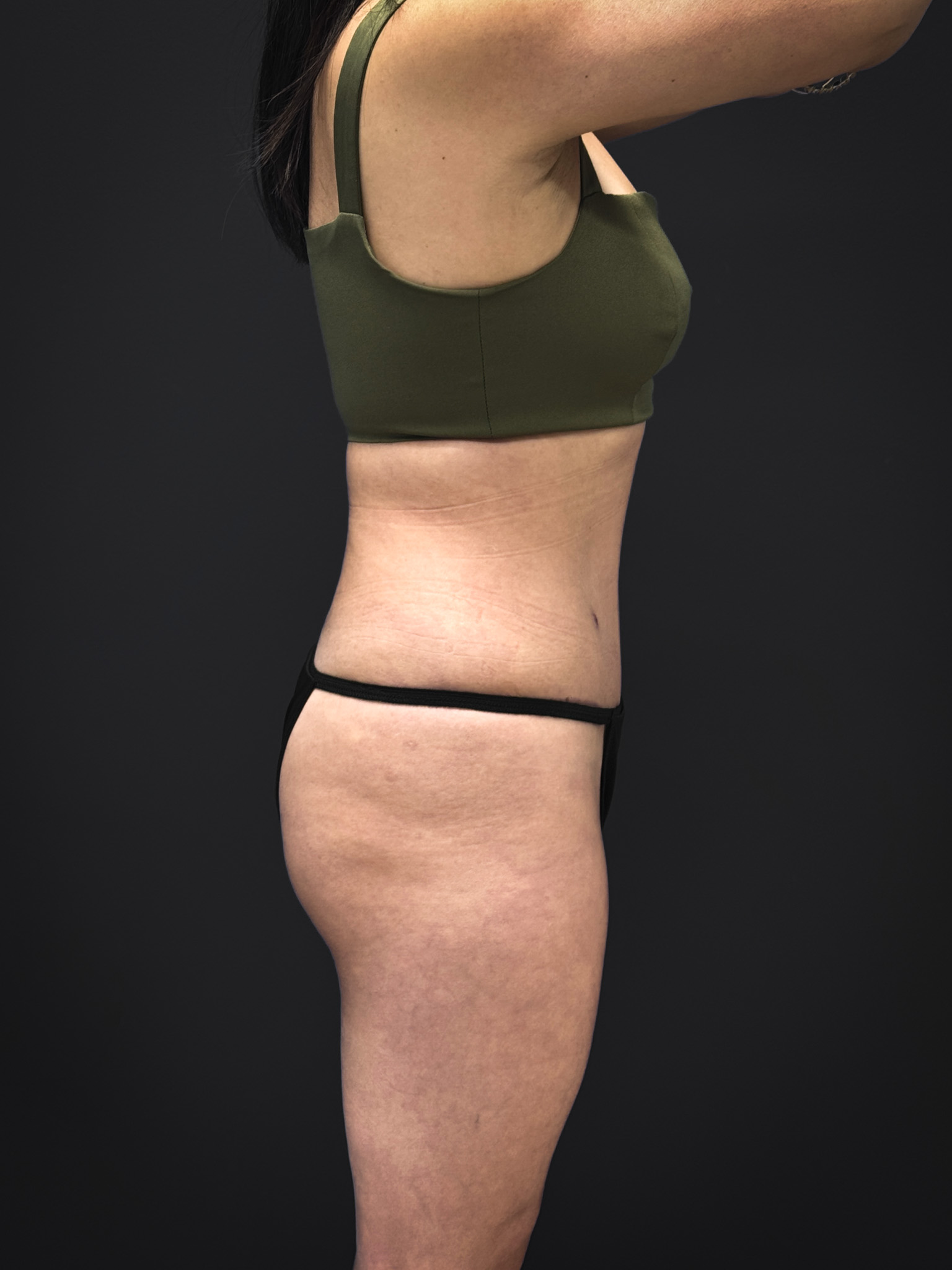 Tummy-Tuck-Case--3757 | After Tummy Tuck 2