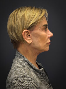 Facelift-Case--4219 | After Facelift 2