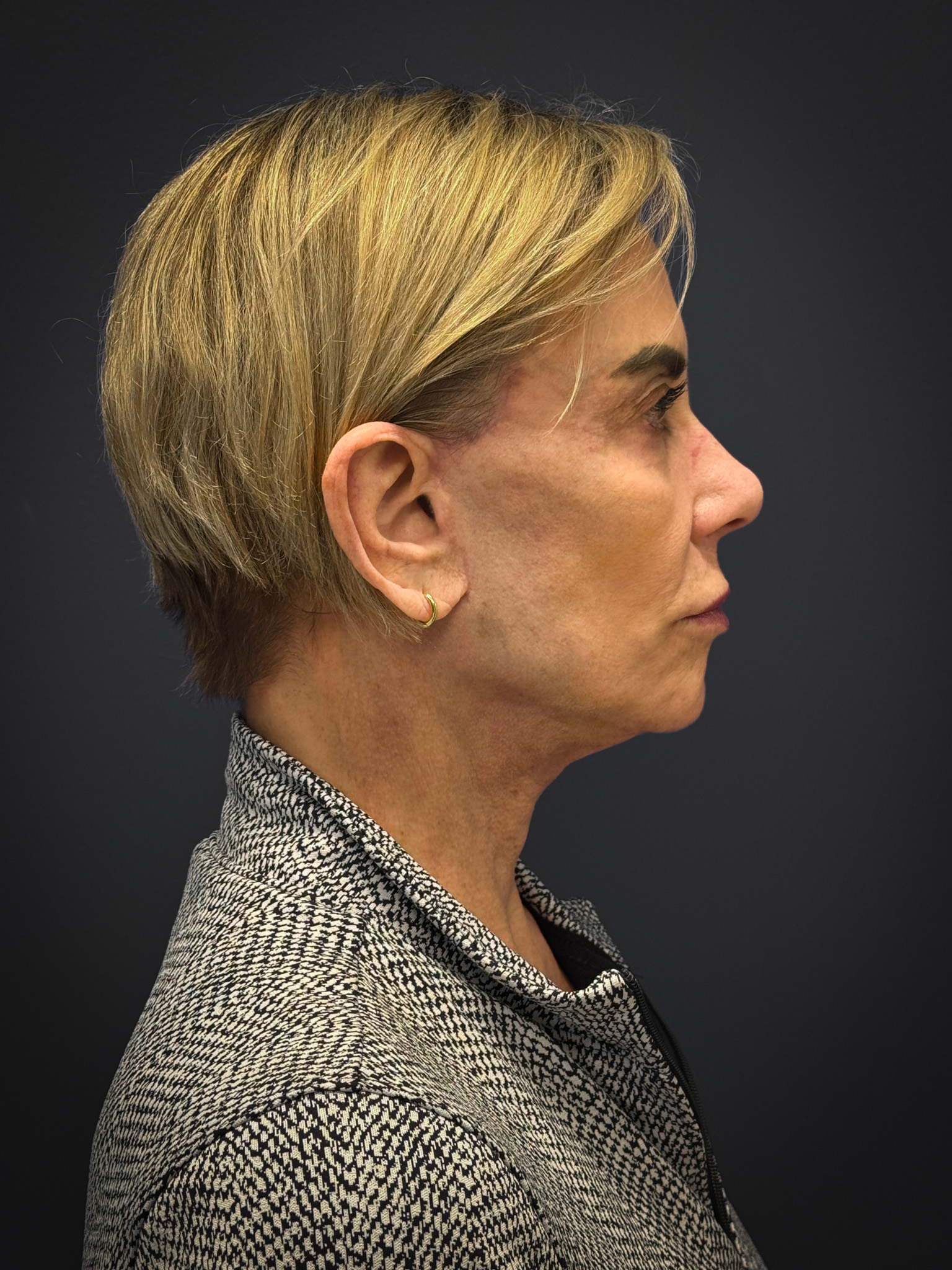 Facelift-Case--4219 | After Facelift 2