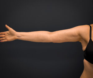 Brachioplasty-Case--3119 | After Arm Lift 1