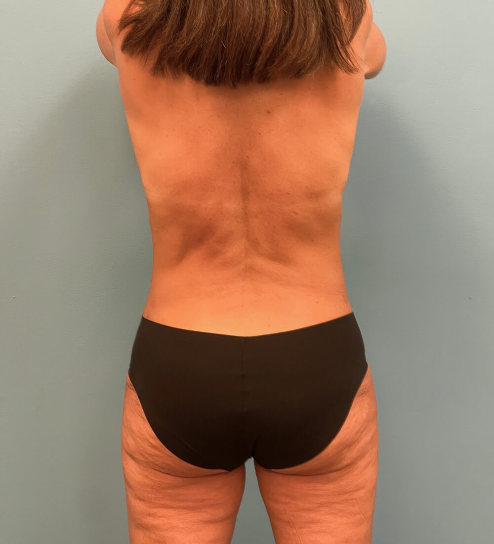 Case--26141 | After Mommy Makeover 2