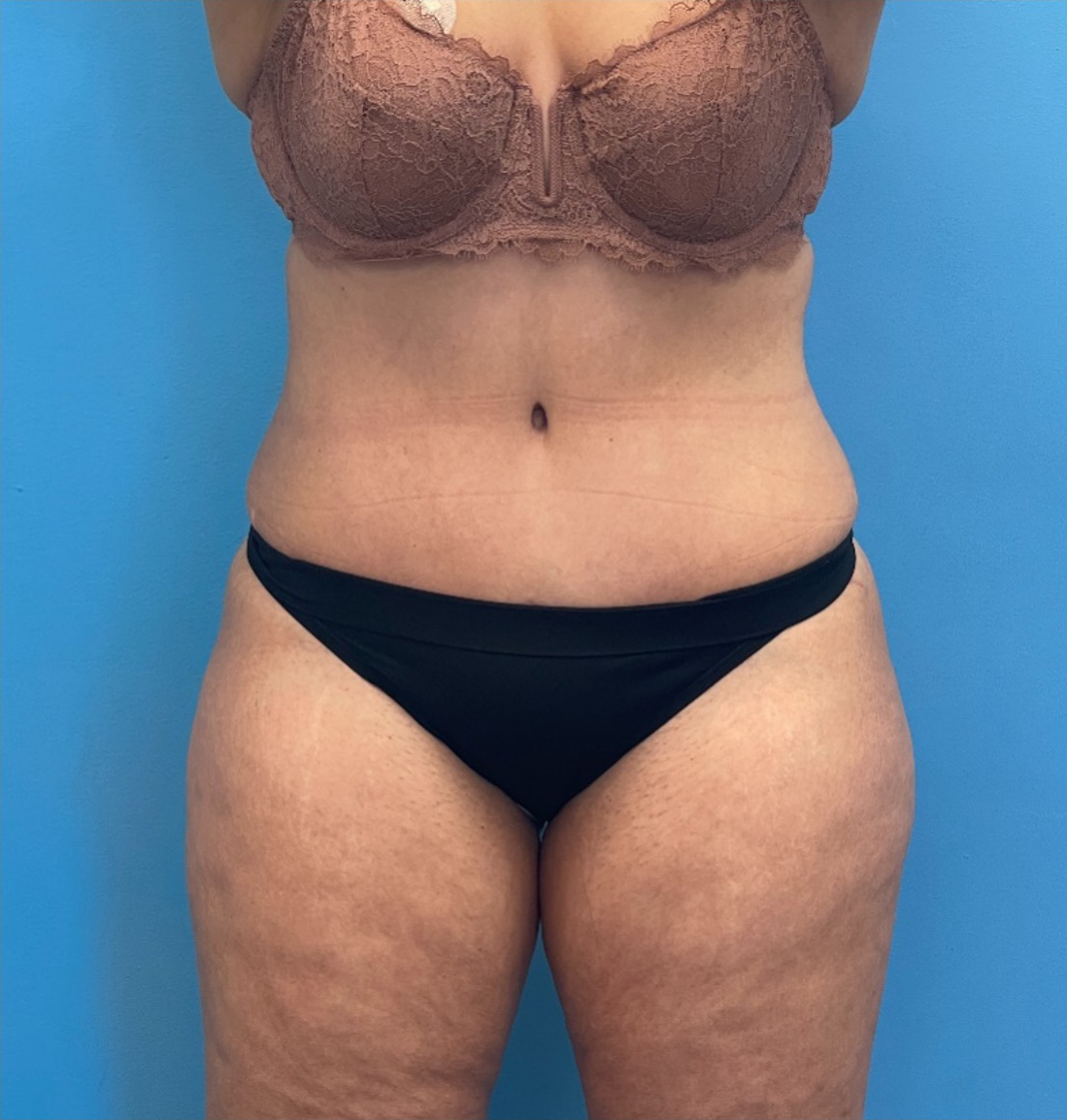 Tummy-Tuck-Case--25555 | After Tummy Tuck 1