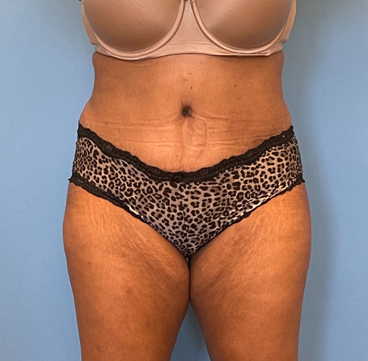 Lipoabdominoplasty-Case--255 | After Liposuction 1