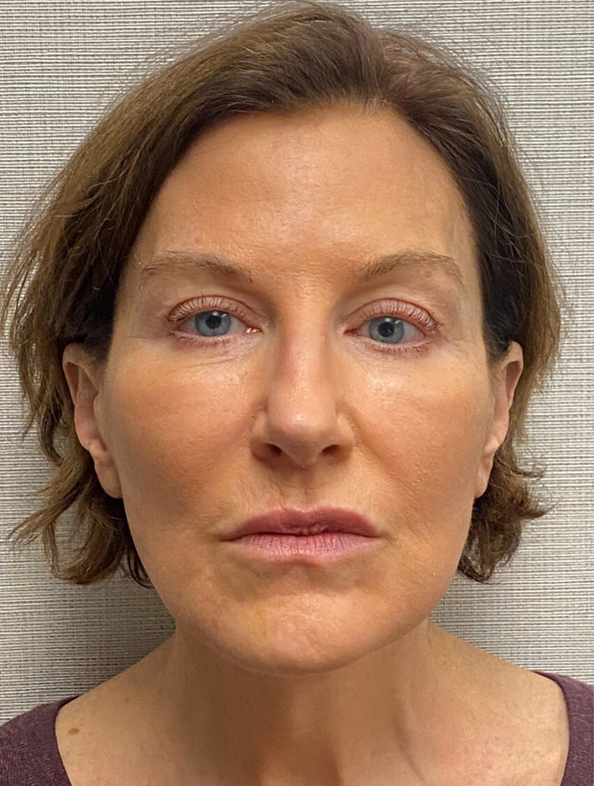 Case--9966 | After Facelift 1