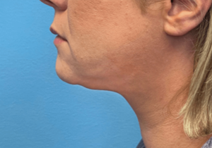 Case--20811 | After Submental Liposuction 1