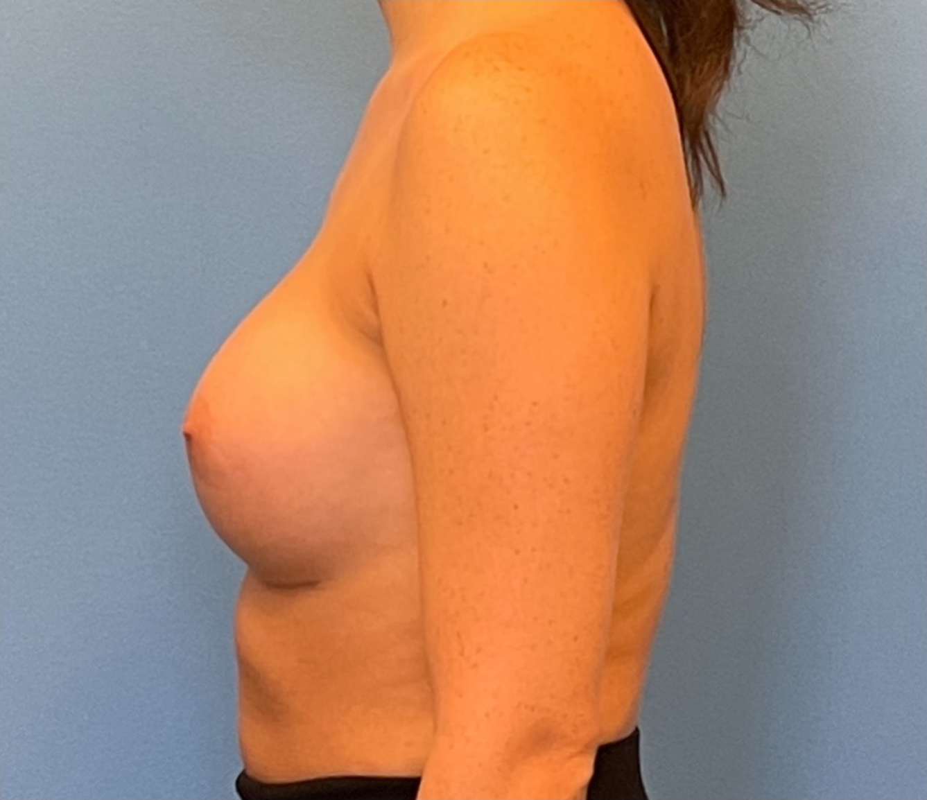 Breast-Augmentation-Case--224 | After Breast Augmentation 2