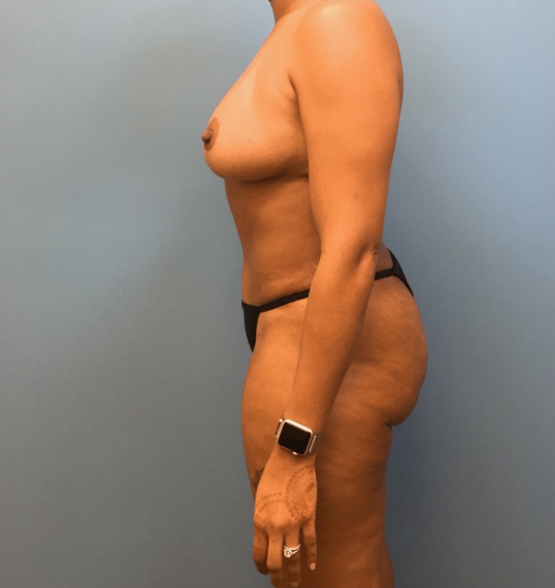 Case--40 | After Mommy Makeover 2